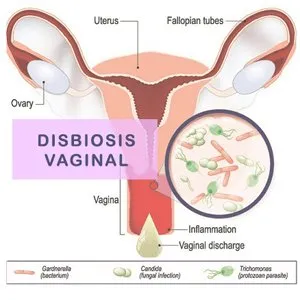 Disbiosis Vaginal - Test para la salud de la mujer