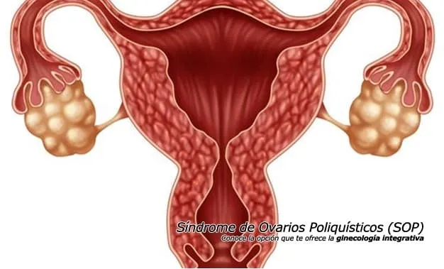 Síndrome de Ovarios Poliquísticos (SOP)